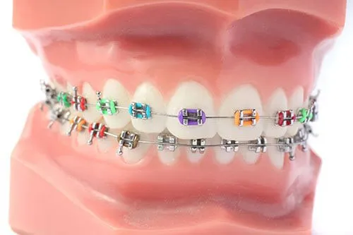 จัดฟันสีใส: การทำให้ฟันสว่างใสไม่เหมือนใคร