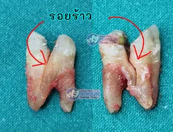 ฟันร้าว ต้องทำอย่างไร