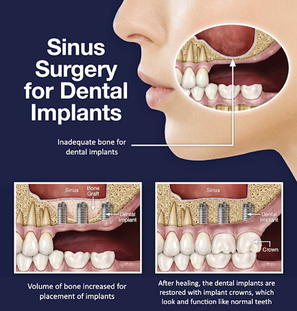 sinus