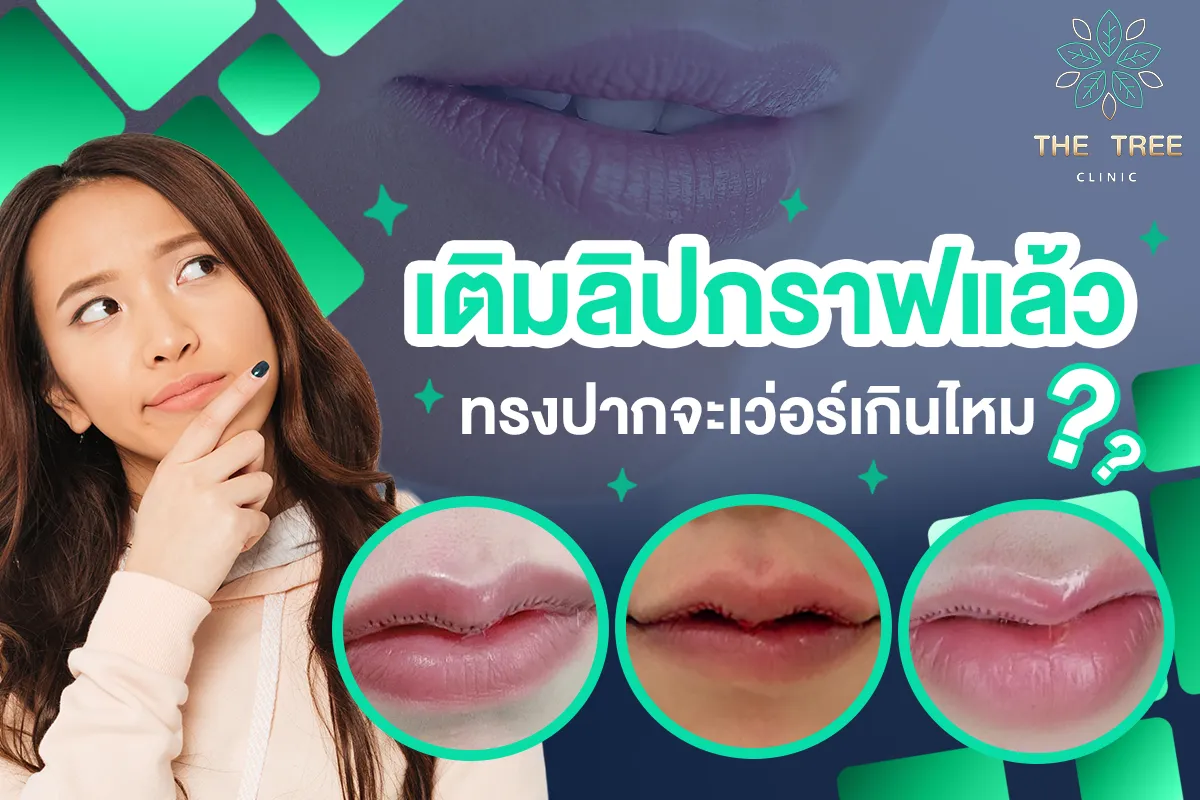 เติมลิปกราฟ