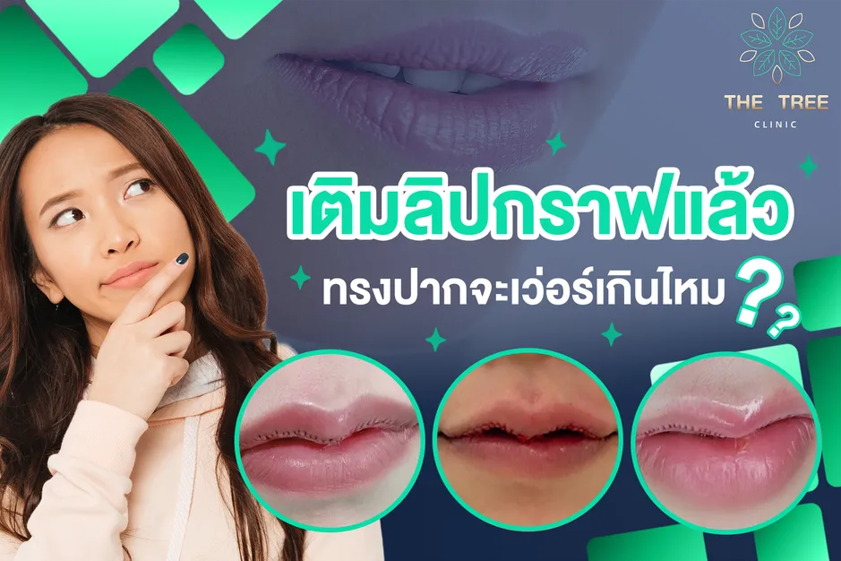 เติมลิปกราฟ