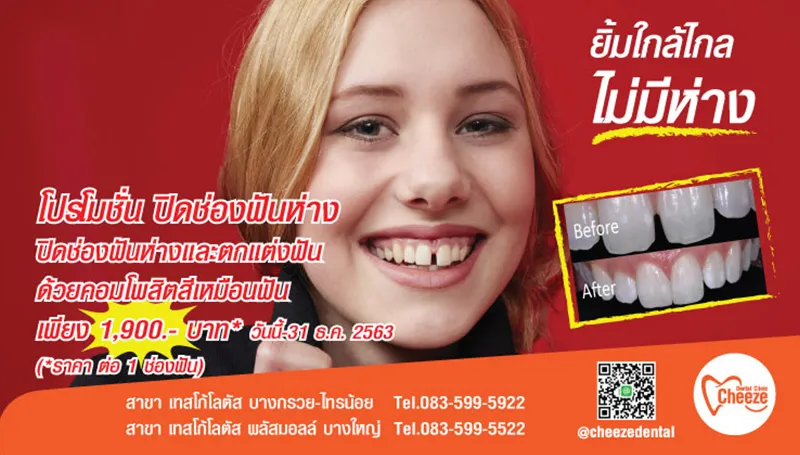TV-Slide-Pro-ปิดช่องฟันห่าง-10-63-1