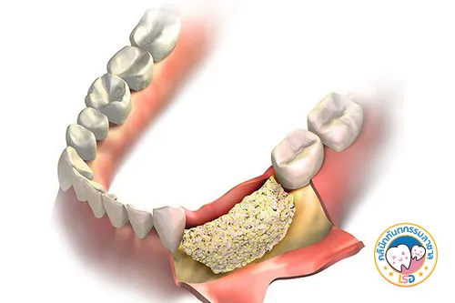 bone-graft1