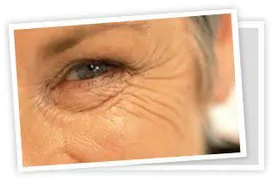 face-lift1