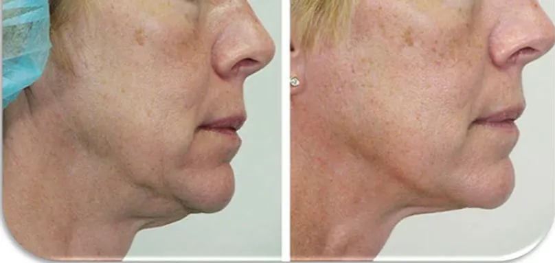 face-lift6