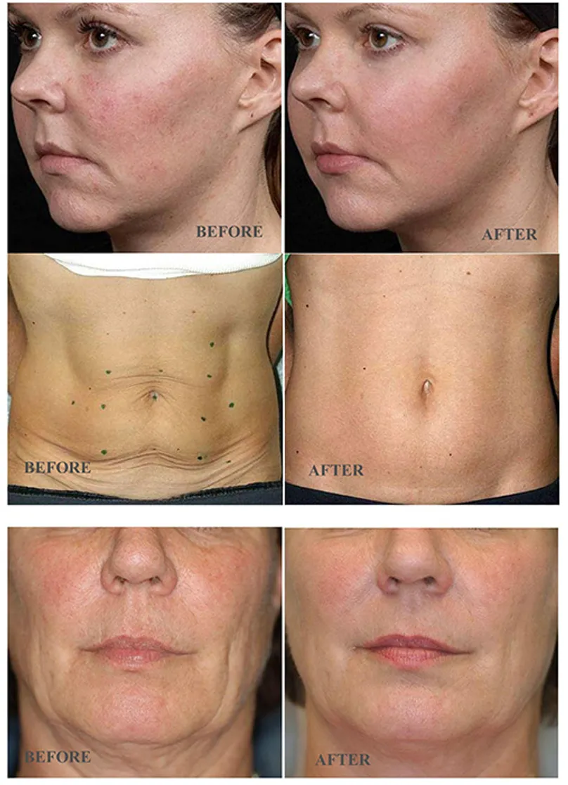 face-lift7