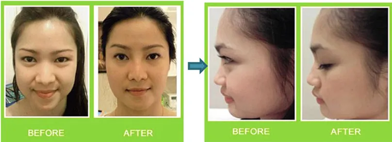 face-lift8
