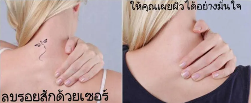 โปรแกรมลดลบรอยสัก5