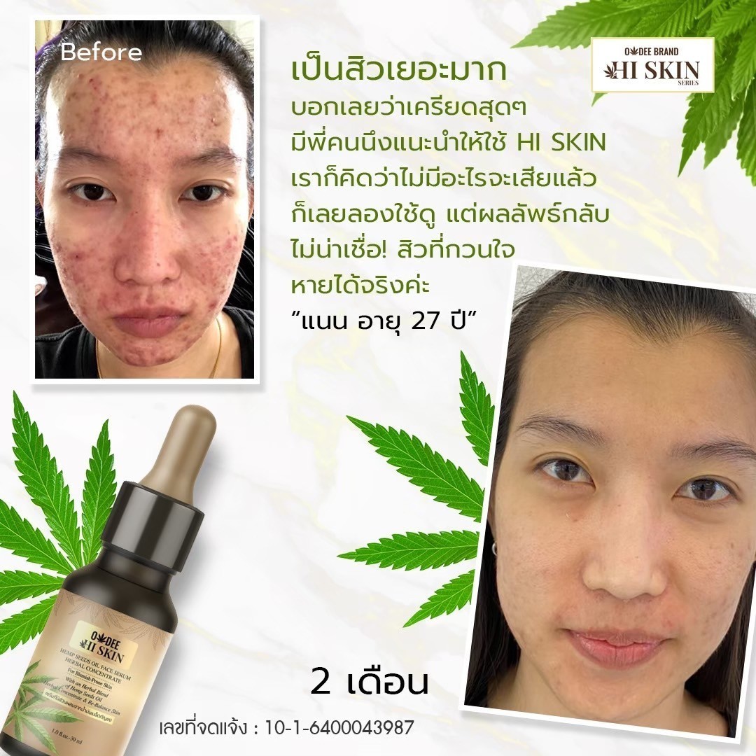 เซรั่มกัญชา