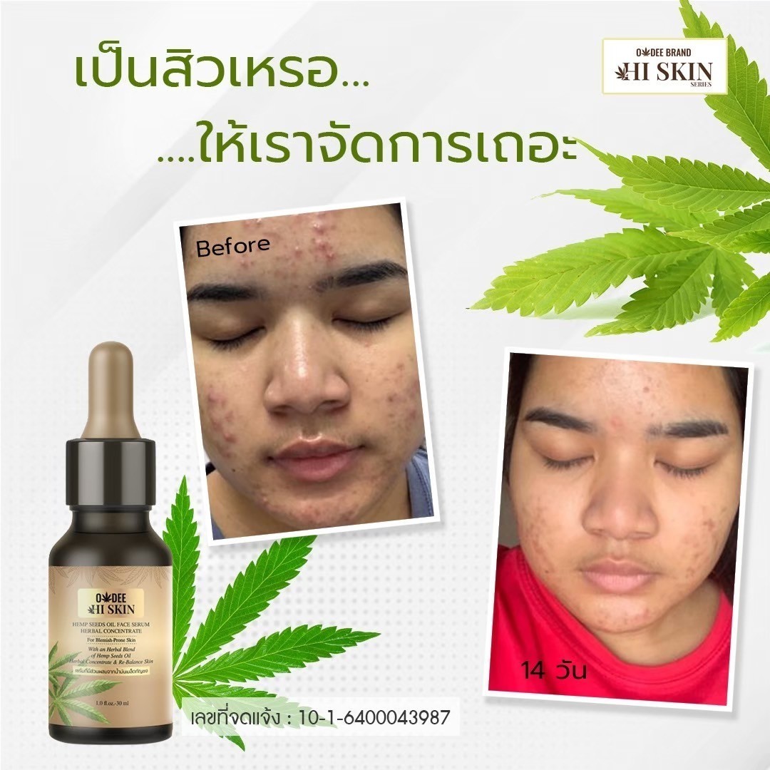 เซรั่มกัญชา
