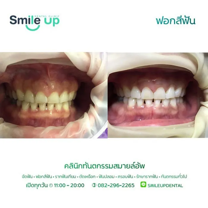 ฟอกสีฟัน1