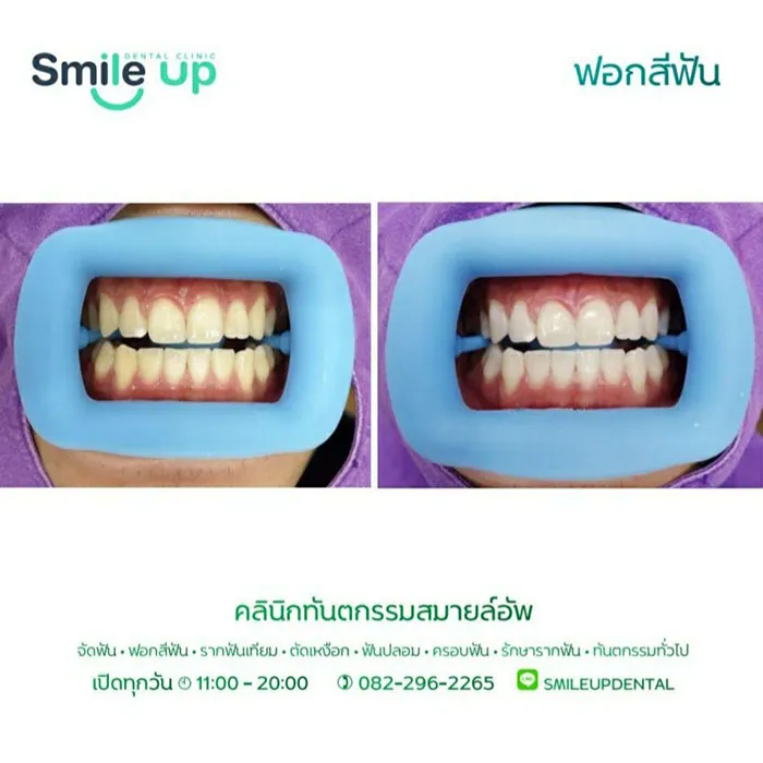 ฟอกสีฟัน2
