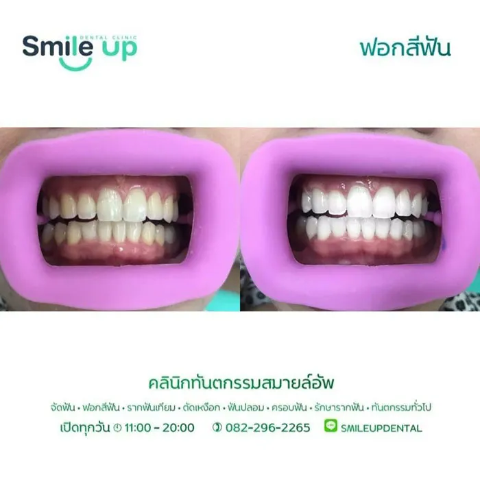 ฟอกสีฟัน3