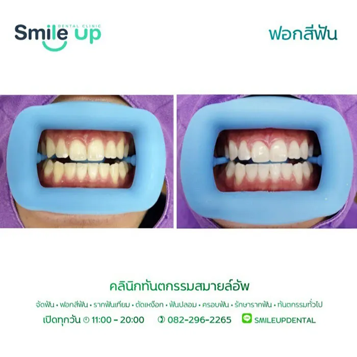 ฟอกสีฟัน4