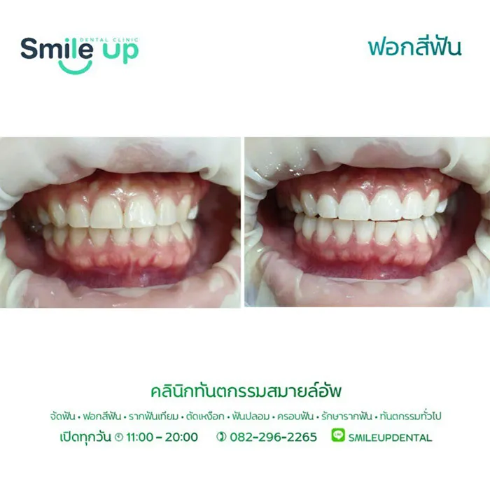ฟอกสีฟัน5