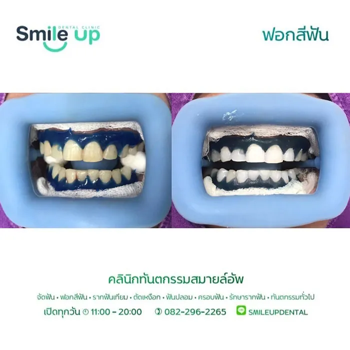 ฟอกสีฟัน6