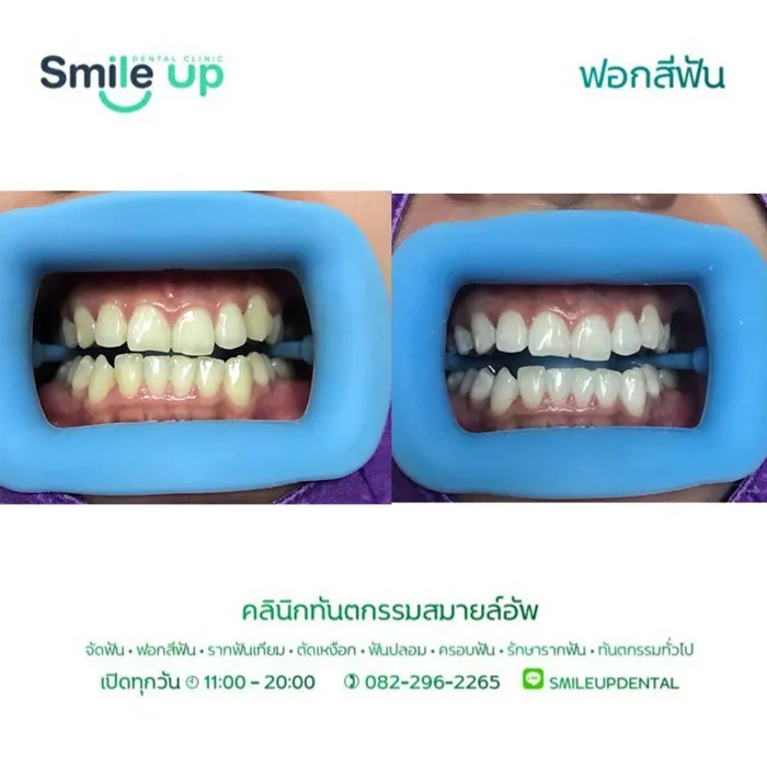 ฟอกสีฟัน7