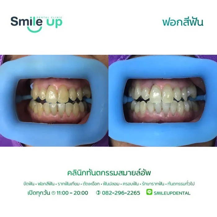 ฟอกสีฟัน8