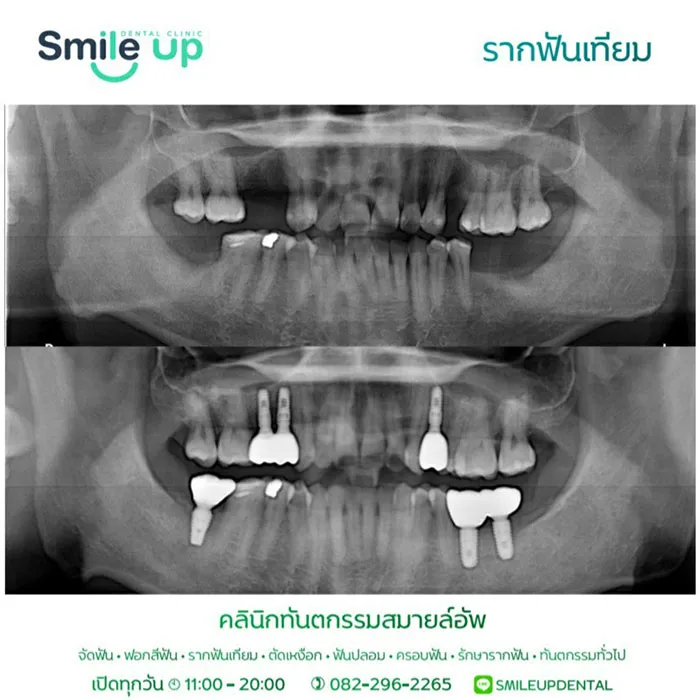 รากฟันเทียม1