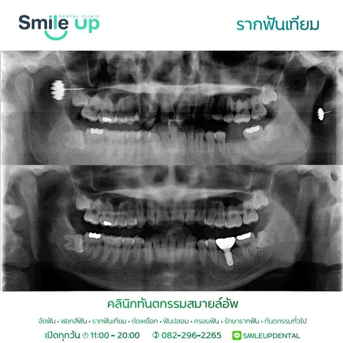 รากฟันเทียม2
