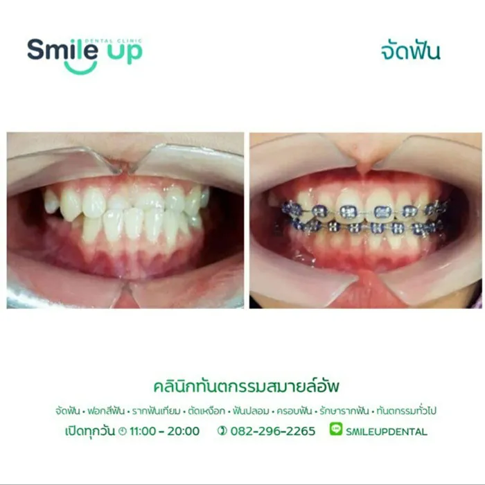 รีวิวจัดฟันsmileup1