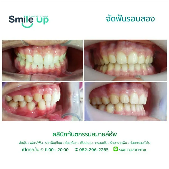 รีวิวจัดฟันsmileup2