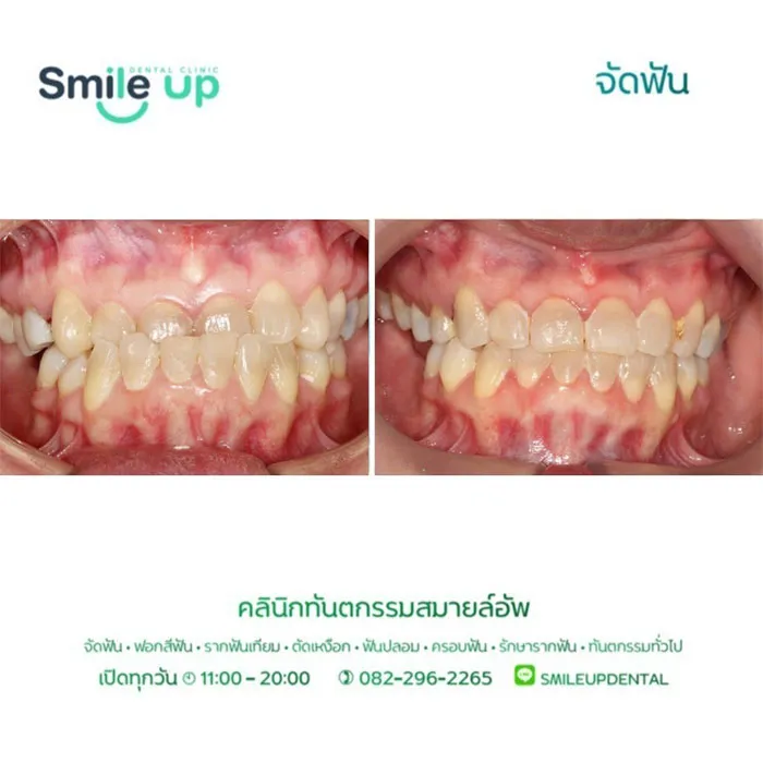รีวิวจัดฟันsmileup3