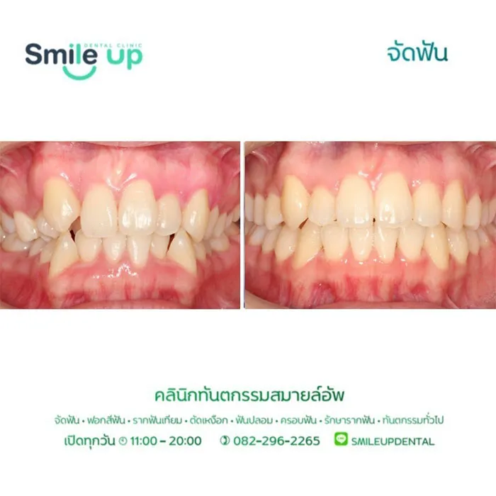 รีวิวจัดฟันsmileup4