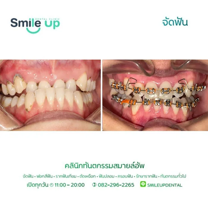 รีวิวจัดฟันsmileup5