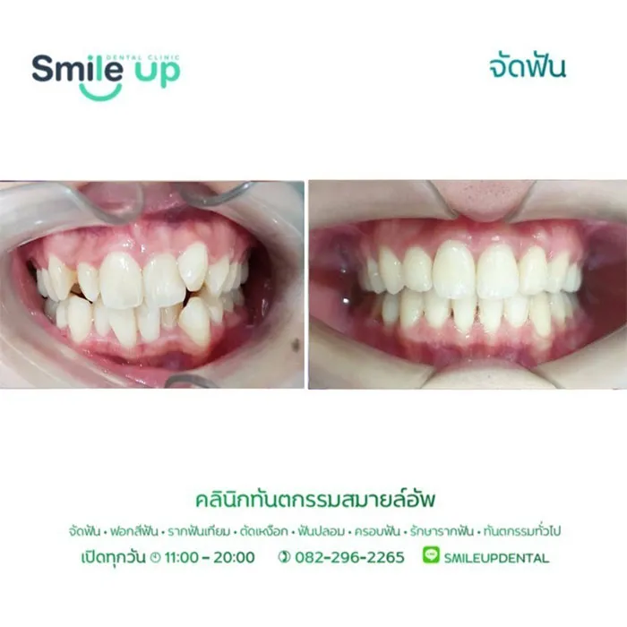 รีวิวจัดฟันsmileup6