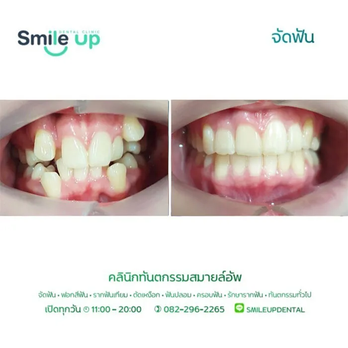 รีวิวจัดฟันsmileup7