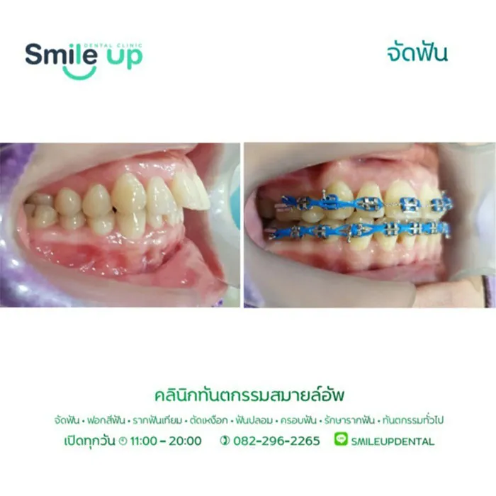 รีวิวจัดฟันsmileup8