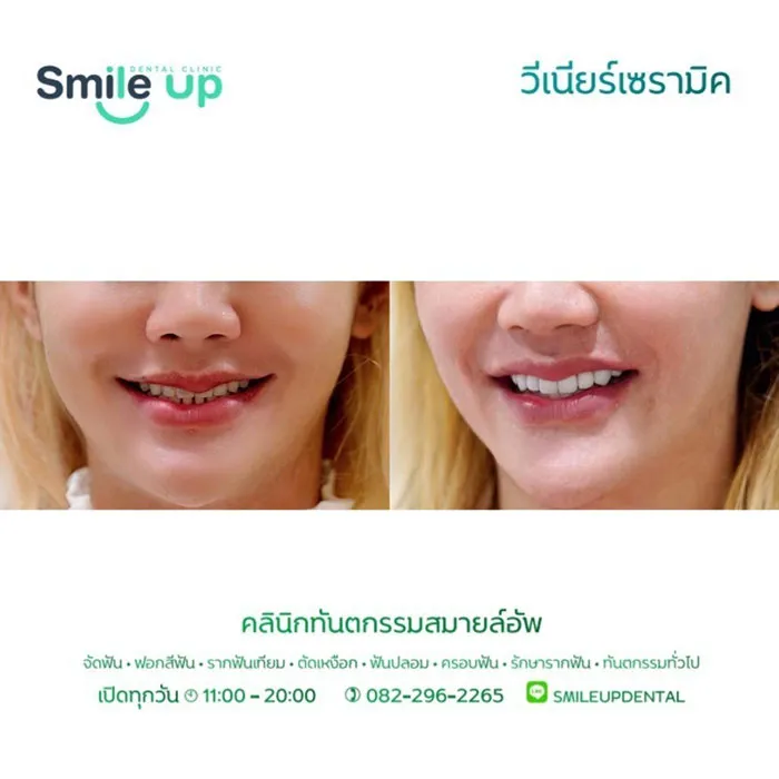 วีเนียร์1