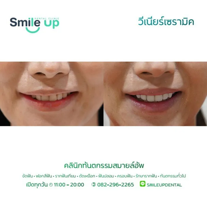 วีเนียร์2