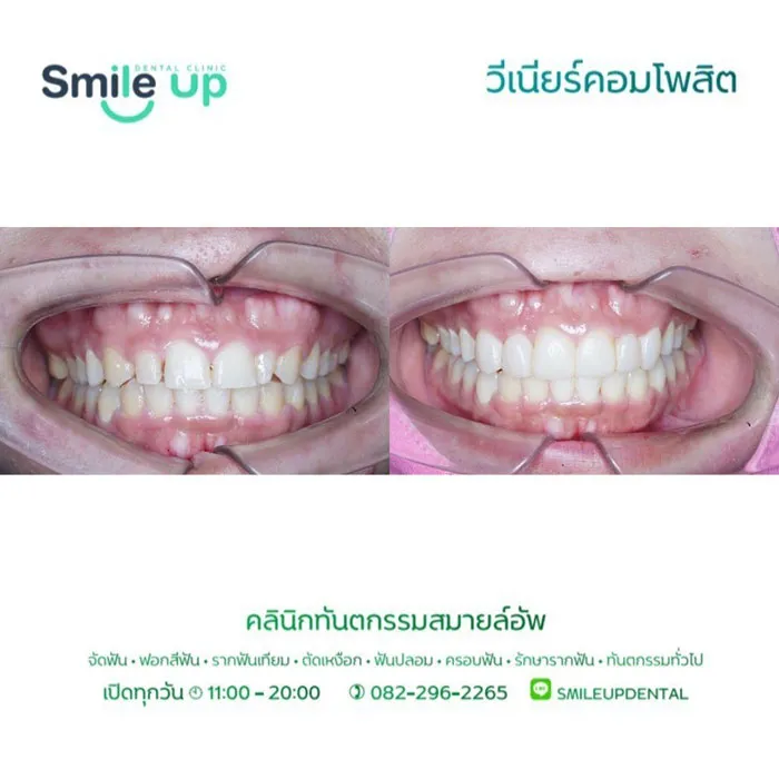 วีเนียร์3