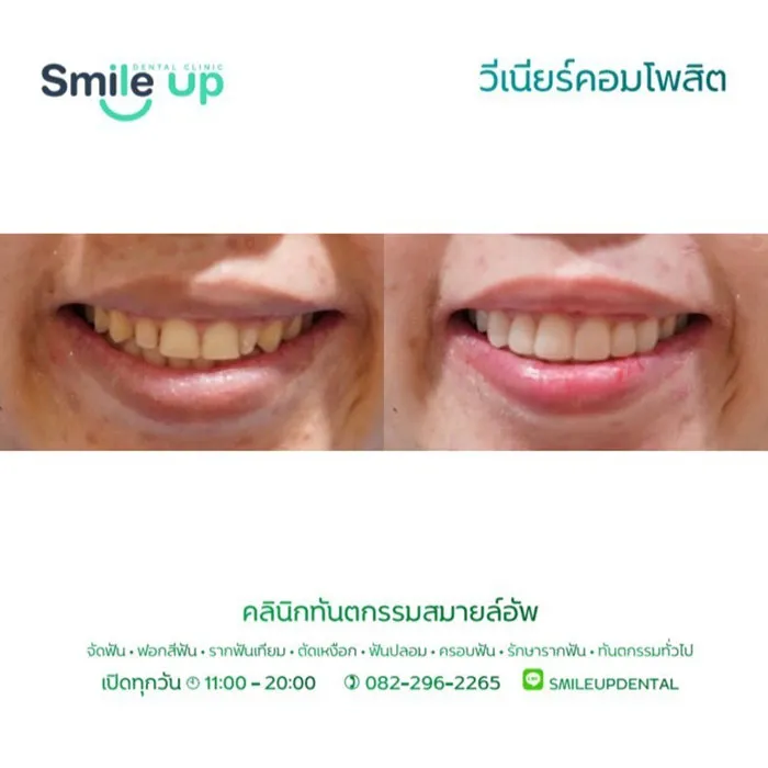 วีเนียร์4