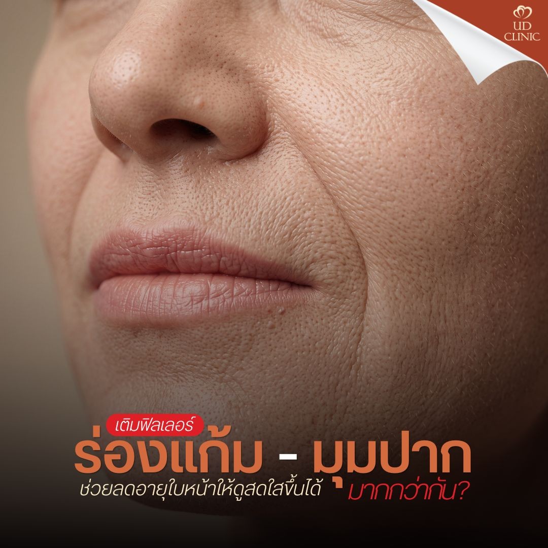 18.2 UD _ ฟิลเลอร์ร่องแก้ม vs ฟิลเลอร์มุมปาก เติมจุดไหนช่วยลดอายุใบหน้าให้ดูสดใสขึ้นได้มากกว่ากัน_