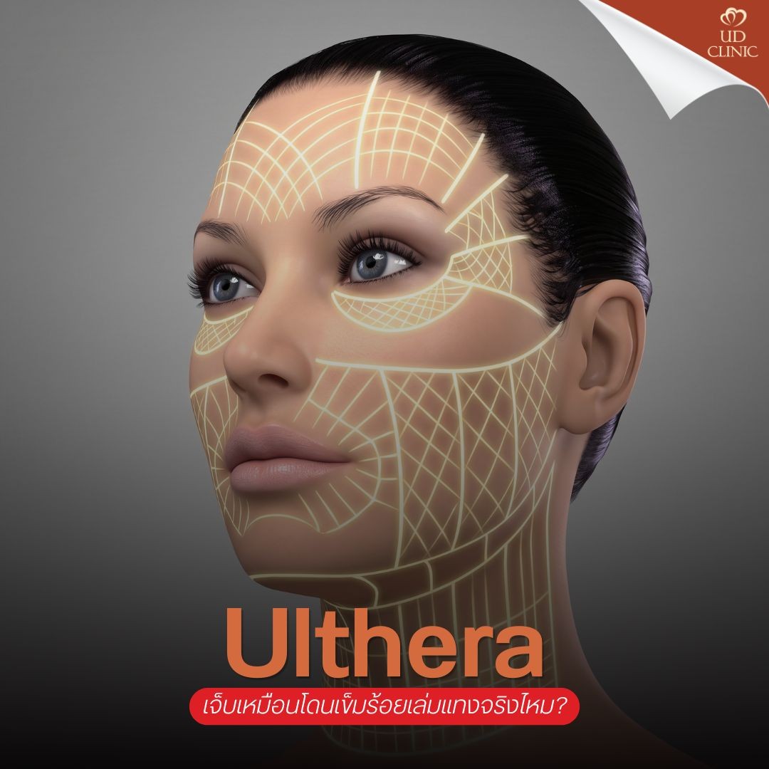 20.2 UD _ ยิง Ulthera เจ็บเหมือนโดนเข็มร้อยเล่มแทงจริงไหม_ รวมวิธีเตรียมใจและเทคนิคแปะยาชาให้เจ็บน้อยลง
