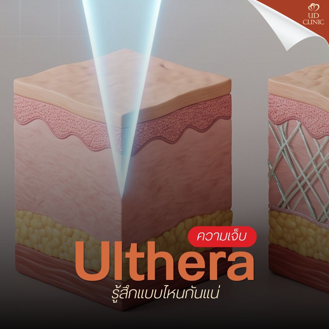 20.3 UD _ ยิง Ulthera เจ็บเหมือนโดนเข็มร้อยเล่มแทงจริงไหม_ รวมวิธีเตรียมใจและเทคนิคแปะยาชาให้เจ็บน้อยลง