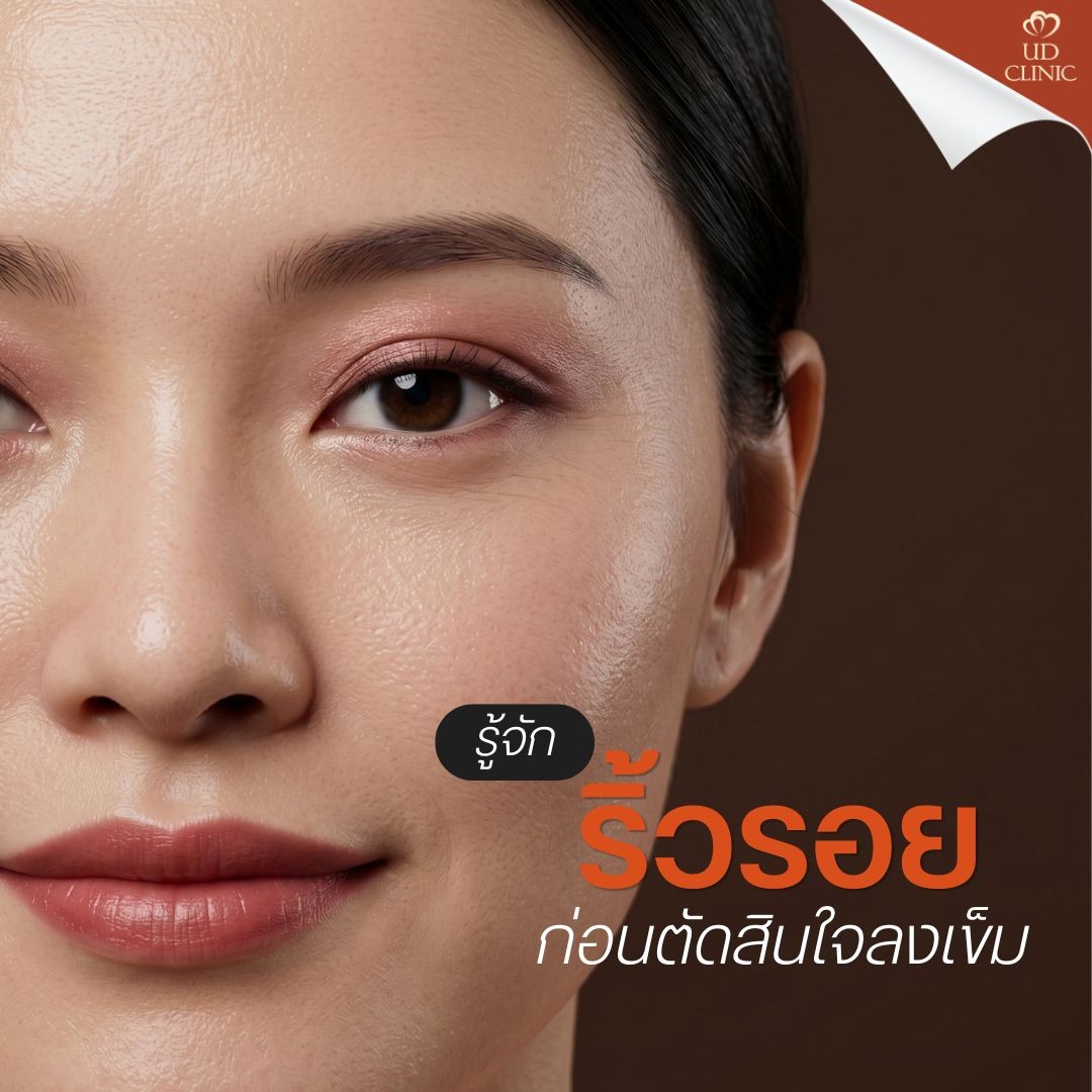 34.2 UD _ ฉีดโบท็อกซ์ลดริ้วรอยหน้าผาก ตา หว่างคิ้ว ควรเริ่มทำตั้งแต่อายุเท่าไหร่_
