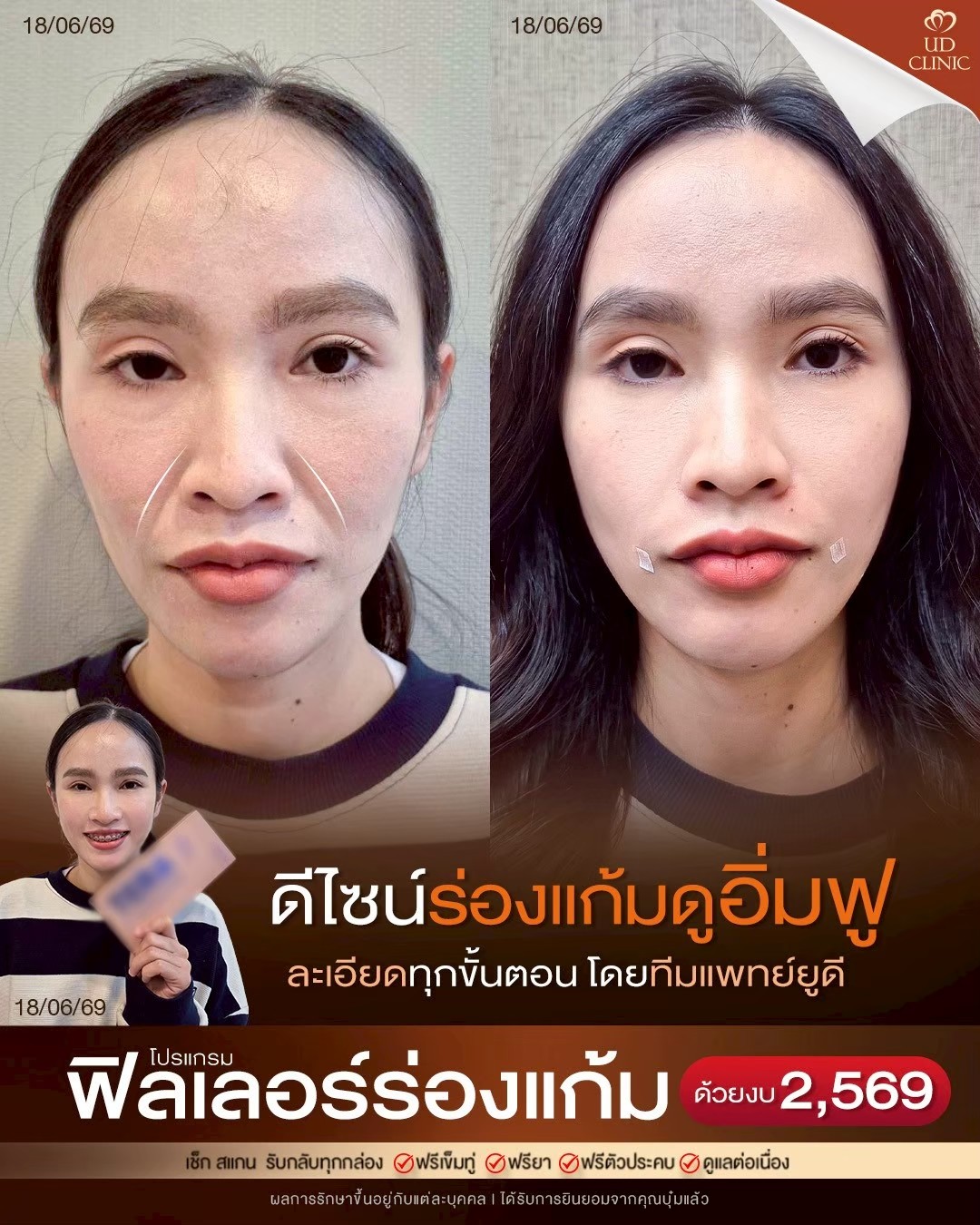 LINE_ALBUM_Skin UD Clinic 2_260910_1