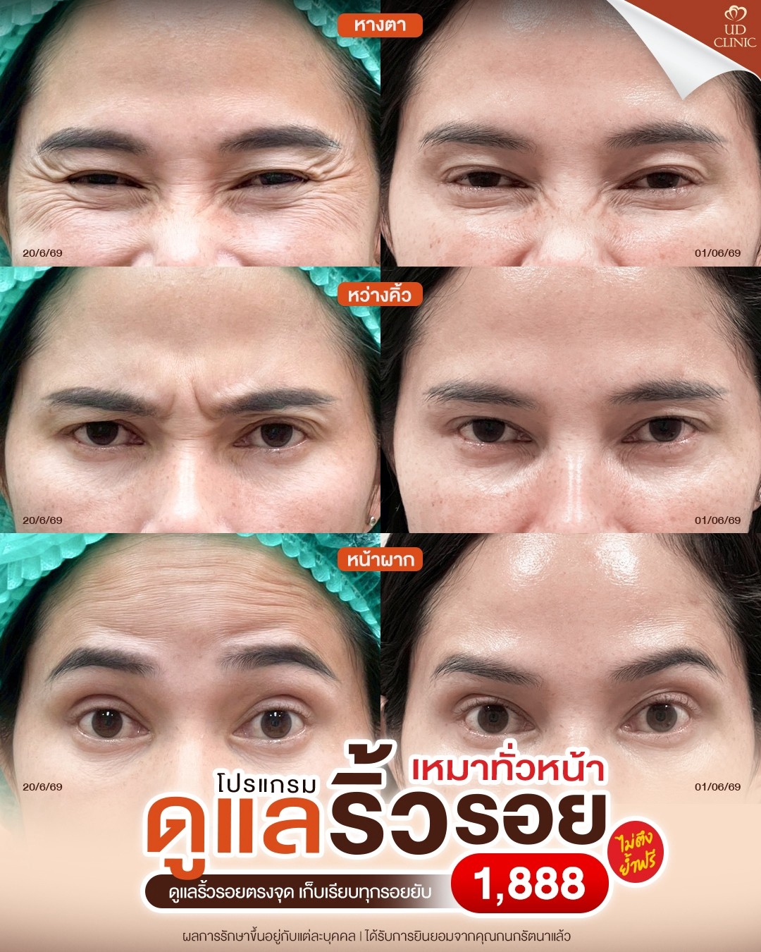 LINE_ALBUM_Skin UD Clinic 3_260815_1
