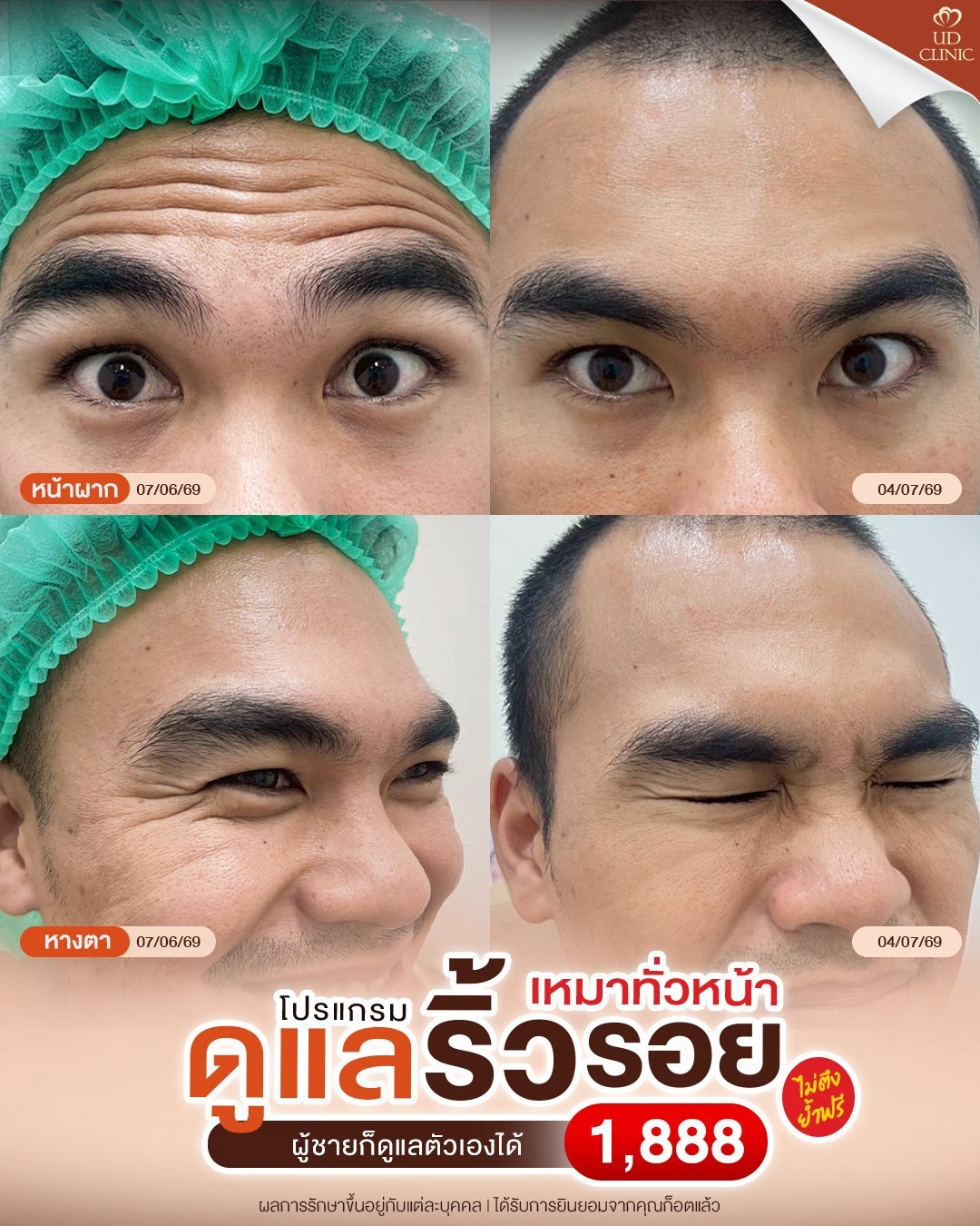 LINE_ALBUM_Skin UD Clinic 3_260815_2