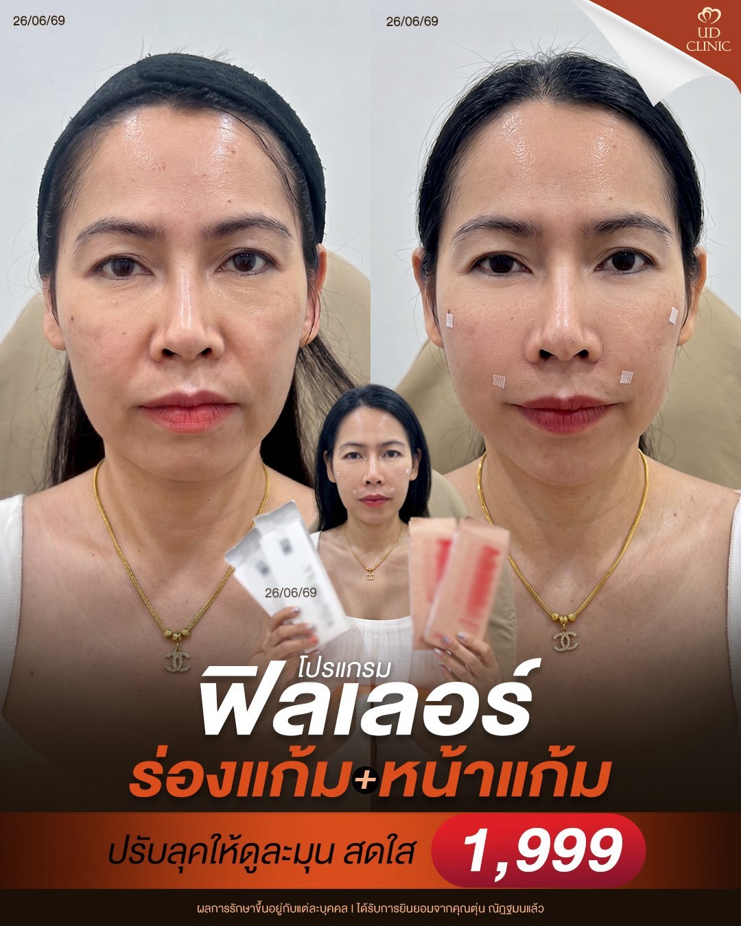 LINE_ALBUM_Skin UD Clinic 3_260829_2