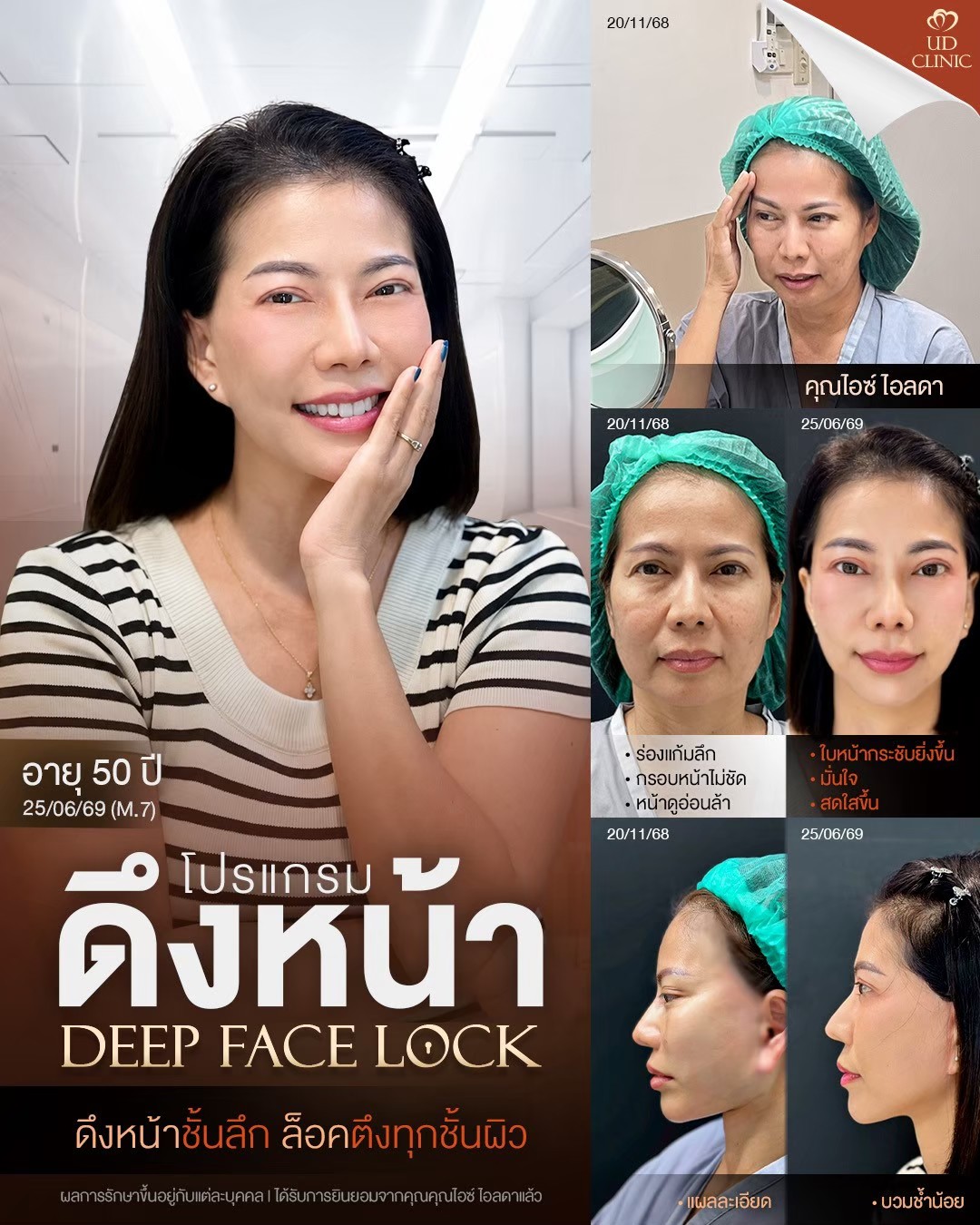 LINE_ALBUM_UD-ศัลยกรรมดึงหน้า 2_260826_2