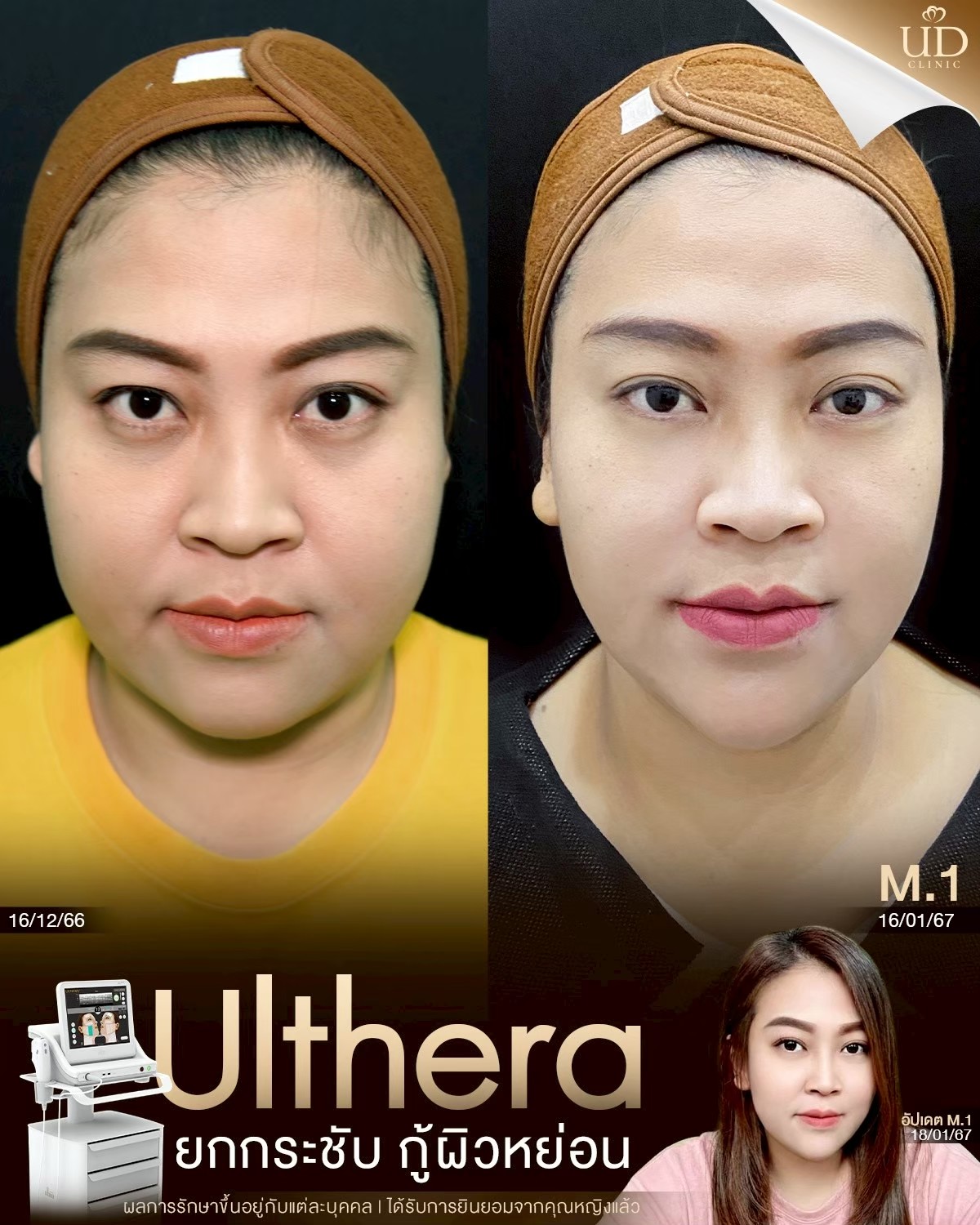 LINE_ALBUM_Skin UD Clinic 2_260814_2