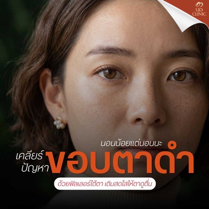 13.1 UD _ นอนน้อยแต่นอนนะ เคลียร์ปัญหา _ขอบตาดำเป็นหมีแพนด้า_ ด้วยฟิลเลอร์ใต้ตา เติมสดใสให้ตาดูตื่น