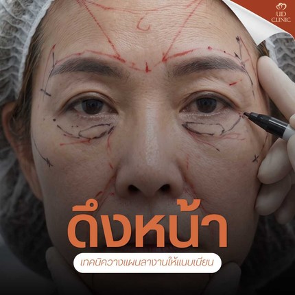 31.2 UD _ ทำงานออฟฟิศอยากดึงหน้า_ วางแผนลางานและ Timeline พักฟื้นหลังดึงหน้าแบบปกติให้แผลเนียนกริบ