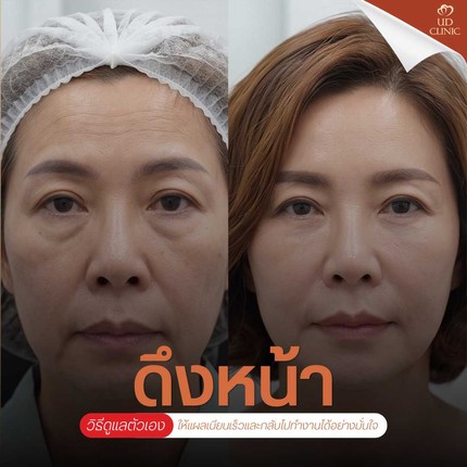 31.3 UD _ ทำงานออฟฟิศอยากดึงหน้า_ วางแผนลางานและ Timeline พักฟื้นหลังดึงหน้าแบบปกติให้แผลเนียนกริบ
