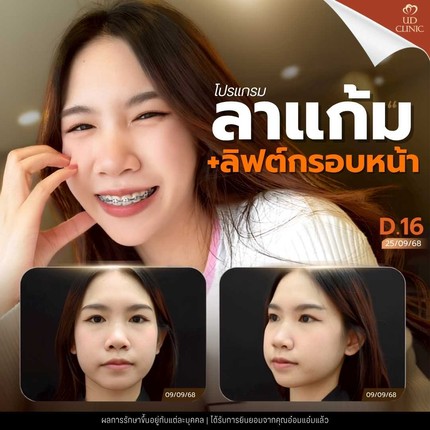 39.4 UD _ เหนียงยุบแต่ผิวย้วย_ ฉีดแฟตสลายไขมันแก้ม-เหนียงอย่างไรไม่ให้ผิวเสียความยืดหยุ่น